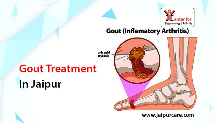 Gout Treatment in Jaipur