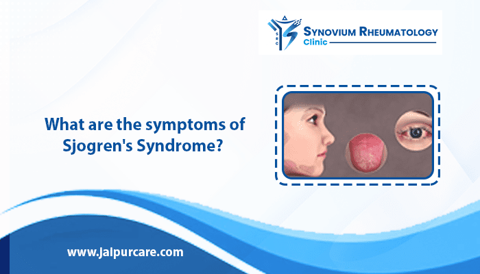 symptoms of Sjogren's Syndrome