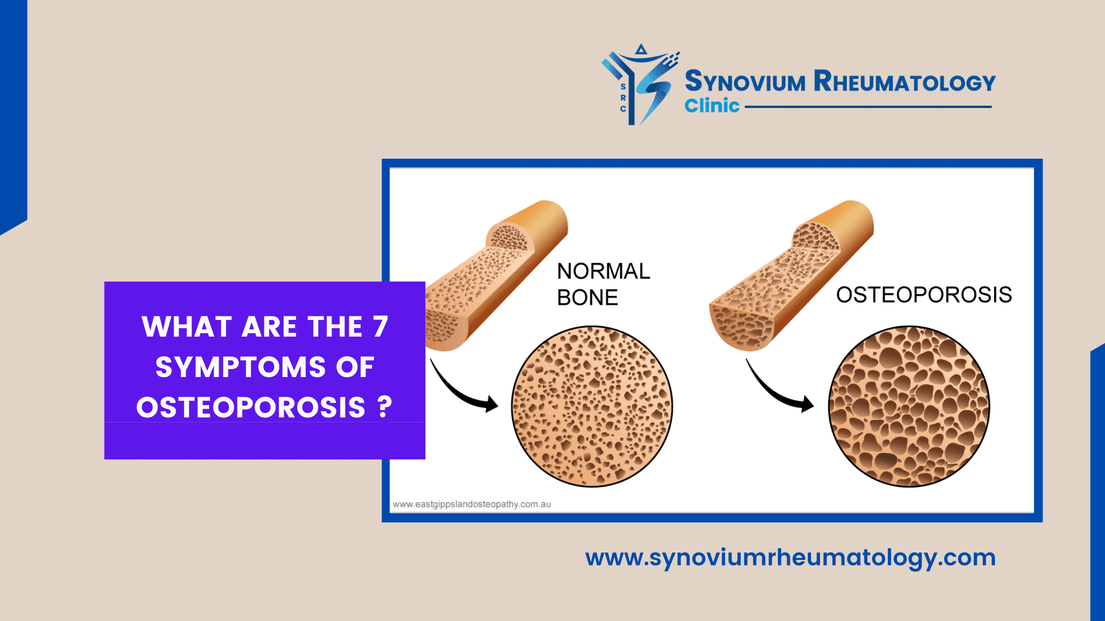 7 symptoms of Osteoporosis