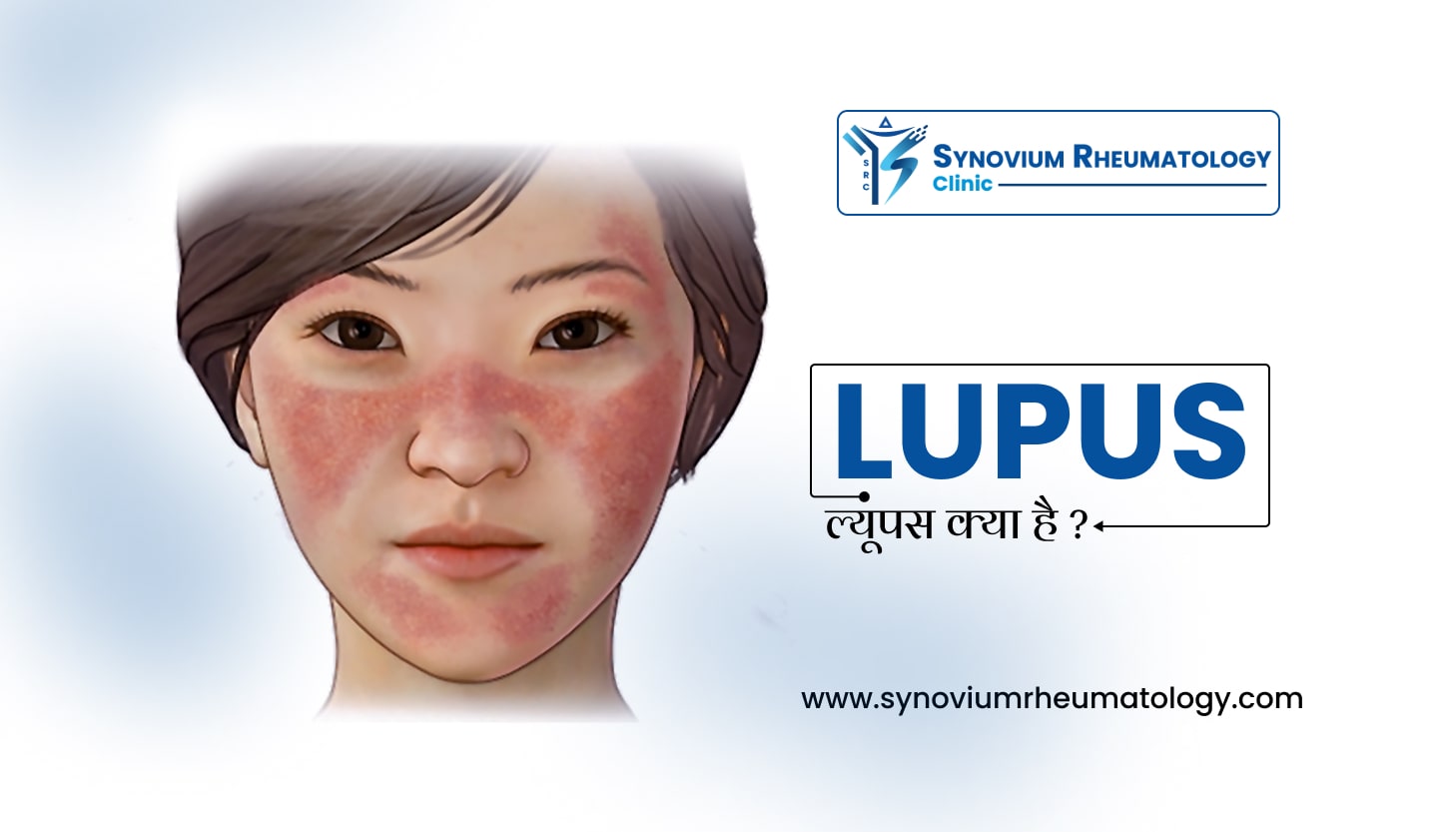Lupus in Hindi