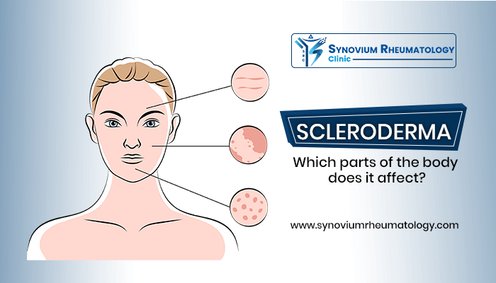 Which parts of the body do scleroderma affect