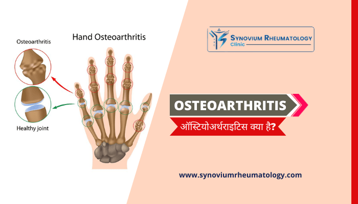 Osteoarthritis in Hindi